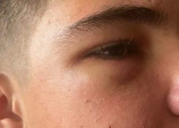 Dječak u Novom Pazaru pretučen poslije utakmice, slomljena mu vilica i jagodična kost