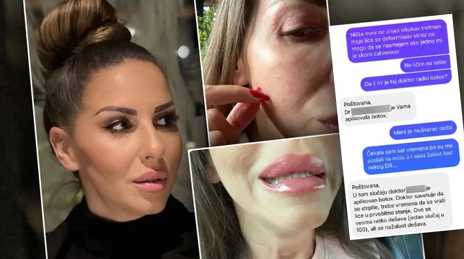 (FOTO)Oprez sa botoksom.Beograđanka priznaje da je posle tretmana BOTOKSA doživela HOROR i da pet meseci ne može da se nasmeje